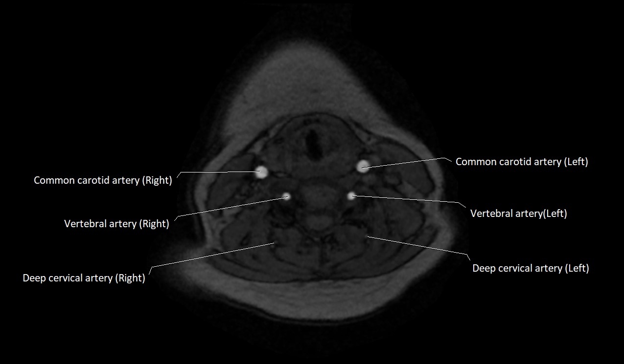 Carotid artery anatomy axial 3T image 40.jpg